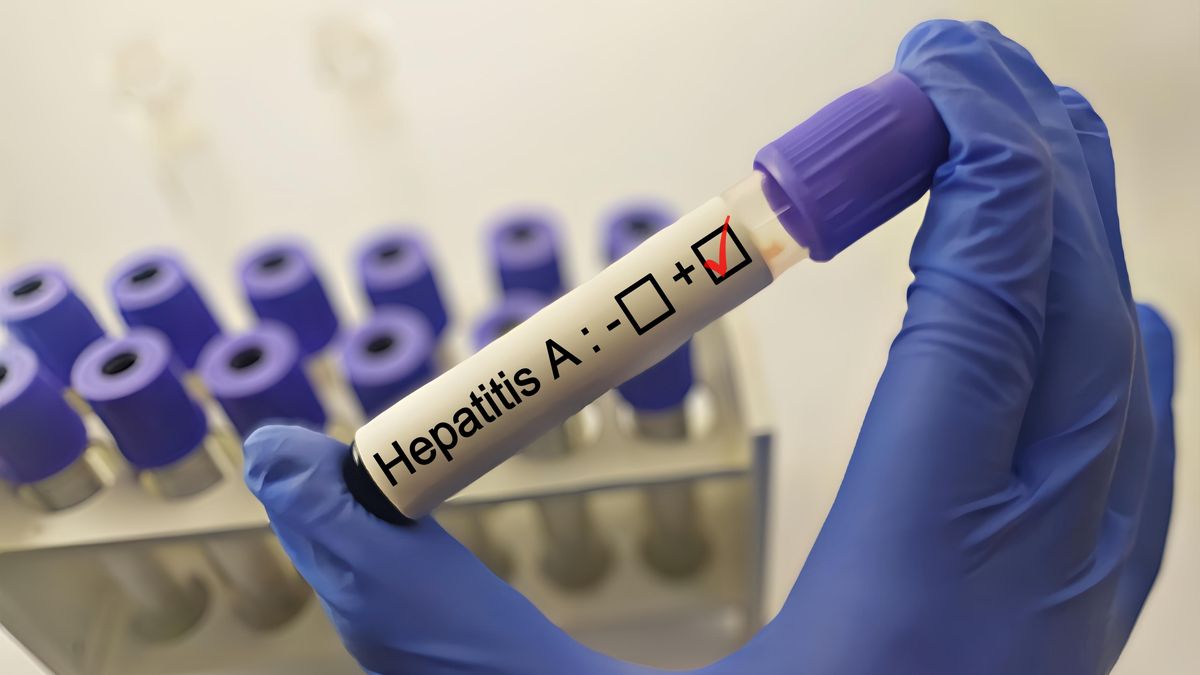 Slovensko hlásí úbytek případů žloutenky typu A, loni jich bylo nejvíc za 20 let